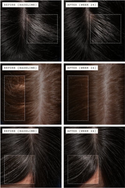 Arey's 'The System' Cuts Gray Hair Growth and Boosts Repigmentation: New Clinicals